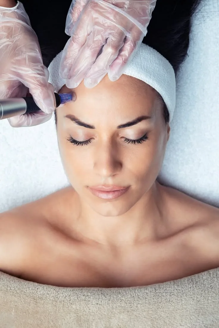 Microneedling